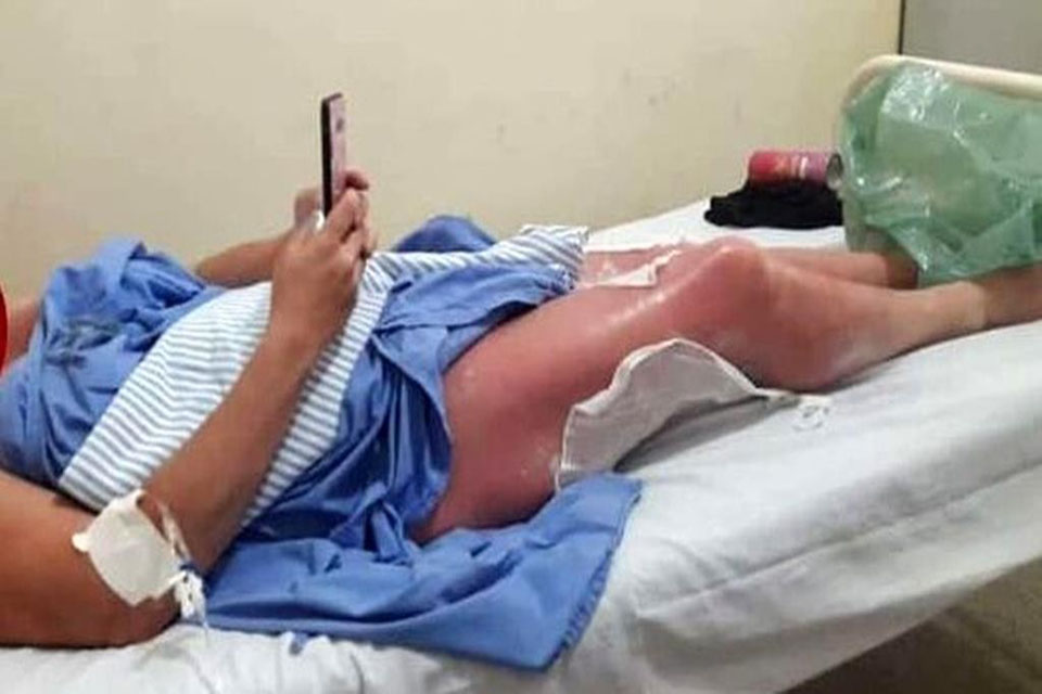 Mulher tem corpo queimado após bronzeamento com chá de folhas de figo