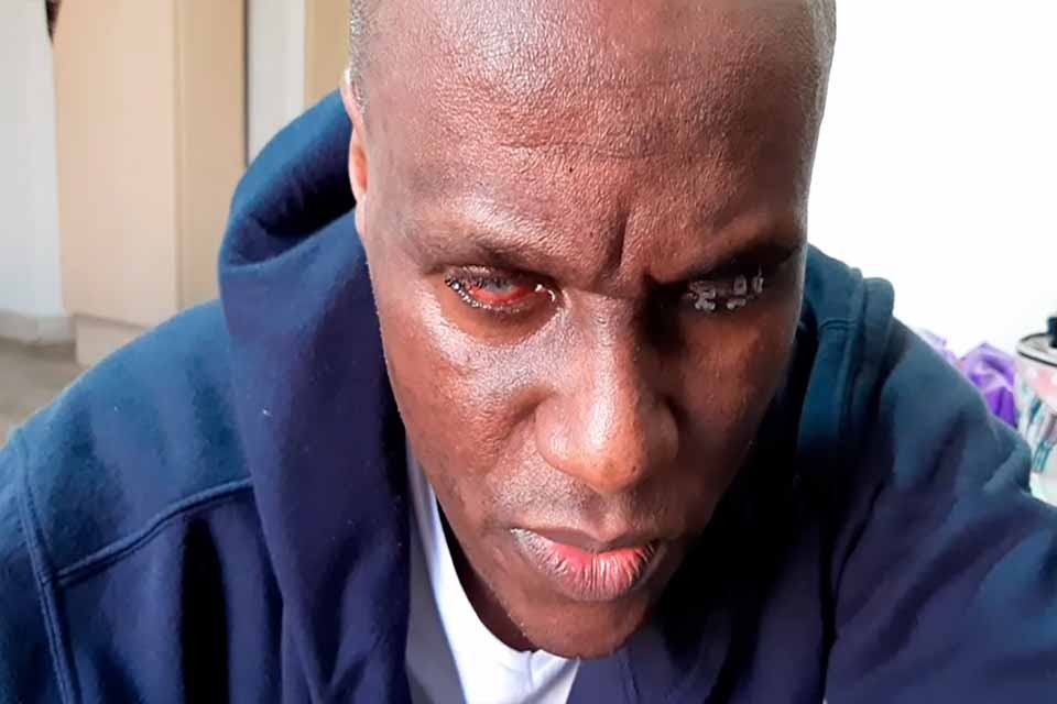 Médico que ficou cego após ser agredido com ácido, diz que julgamento foi injusto e um engodo